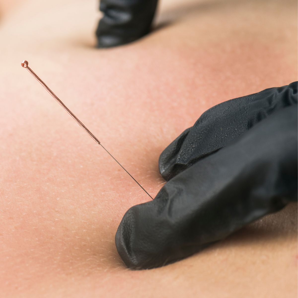 Dry Needling vs Acupuncture