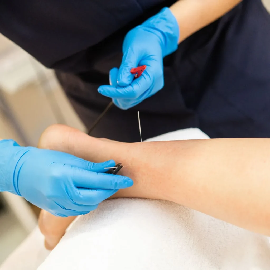 A person wearing blue gloves inserts acupuncture needles into the lower leg of another person lying on a white towel, performing a therapeutic treatment.
