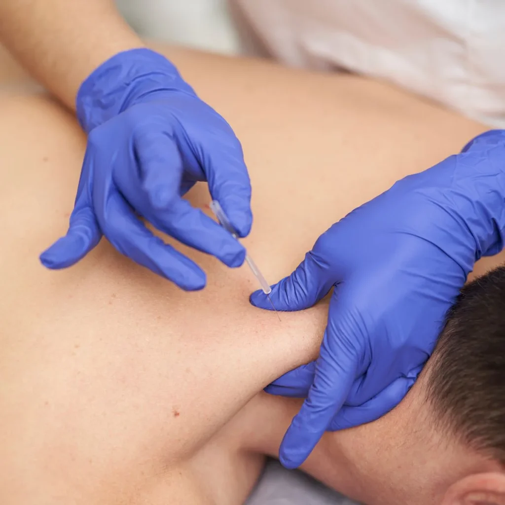 A person wearing blue latex gloves inserts an acupuncture needle into the shoulder of a person lying face down, focusing on the shoulder area.