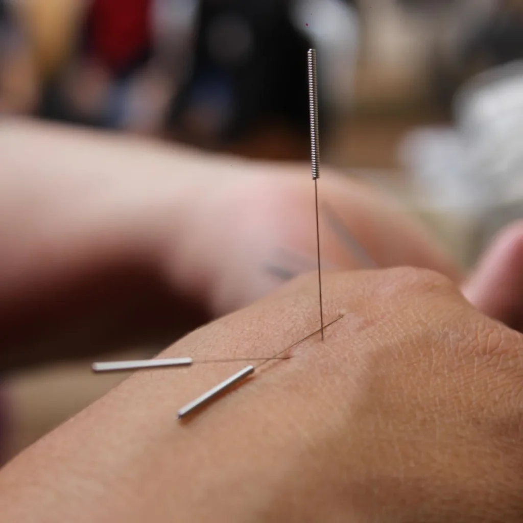 Close-up of a hand with three thin acupuncture needles inserted into the skin, demonstrating an acupuncture treatment. The background is blurred and out of focus.