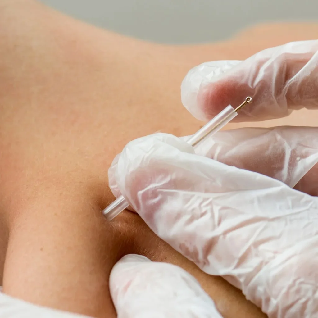 A close-up of hands wearing white gloves extracting a blemish from skin using a metal comedone extractor tool.