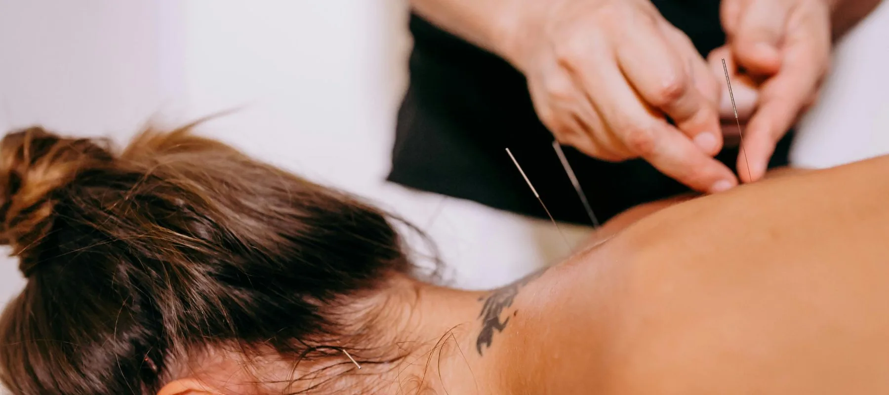 What Does Dry Needling Actually Do?